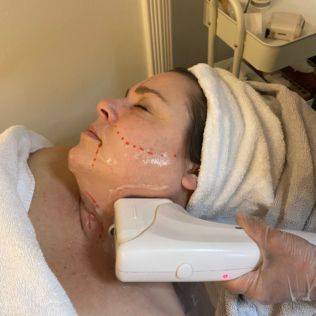HIFU: The Non-Surgical Facelift That Lifts, Tightens & Rejuvenates