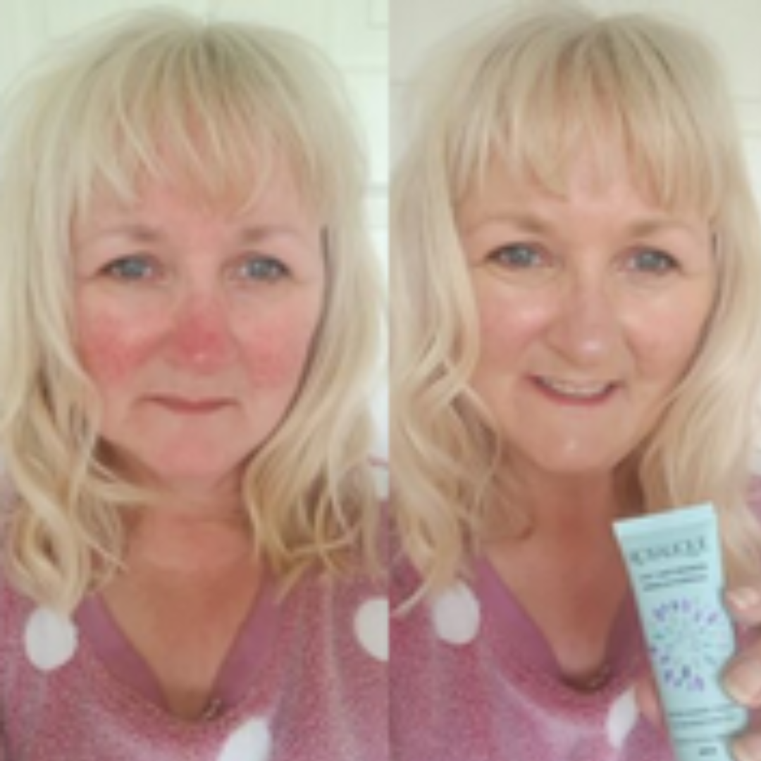 rosalique-anti-redness-solution