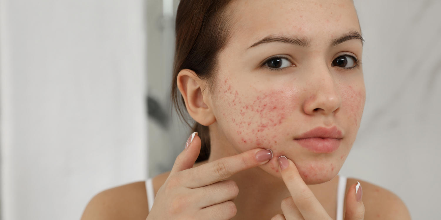 Say Goodbye to Acne with Medik8's Range of Products