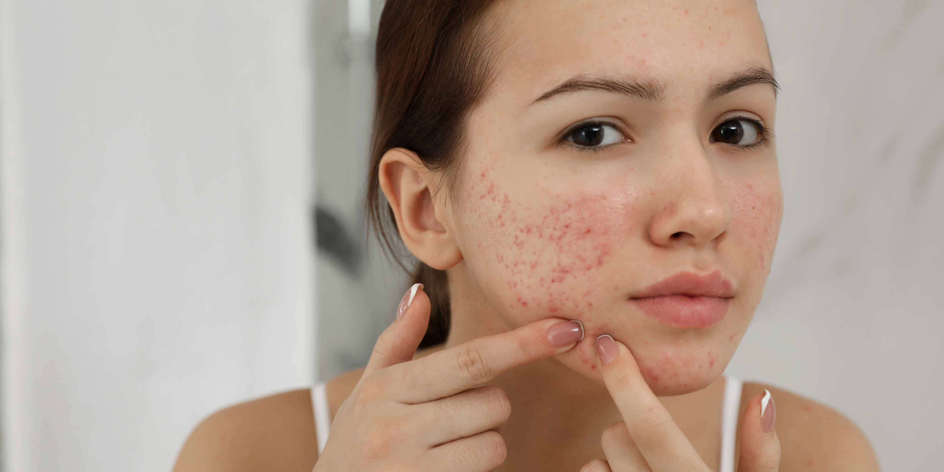 What Are The Best Products for Acne-Prone Skin?