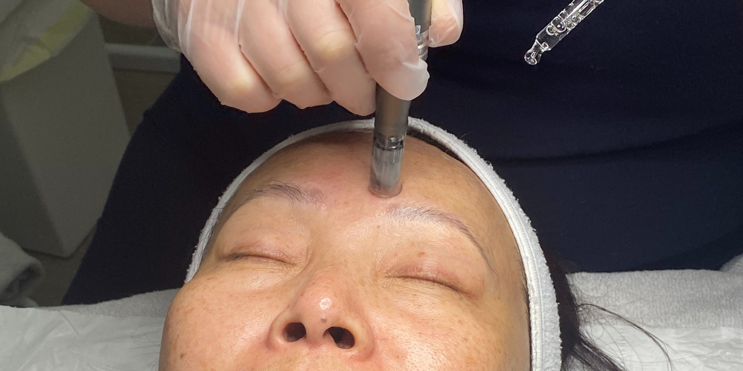 Microneedling: A Skincare Revolution for Ageless Beauty