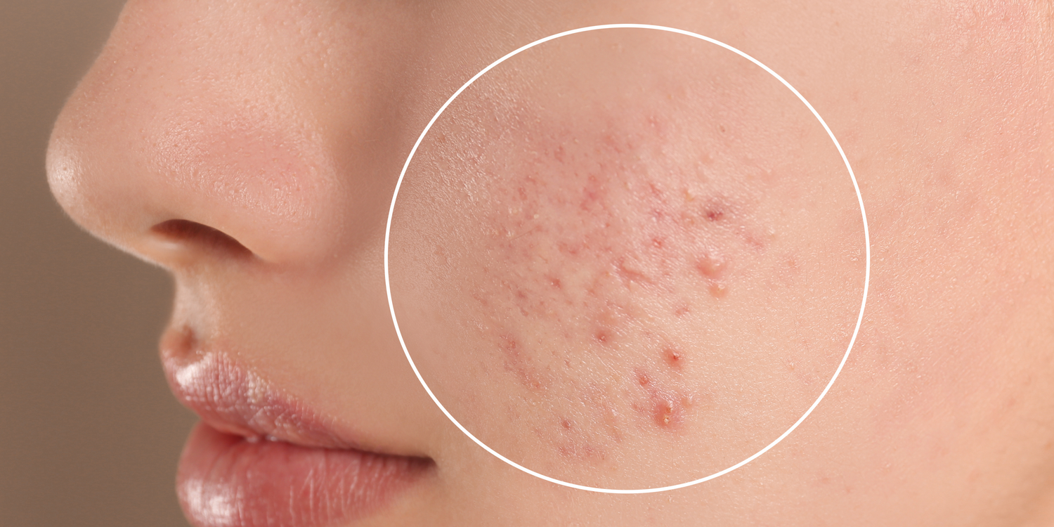 The Four Key Effects of Acne and How to Combat Them