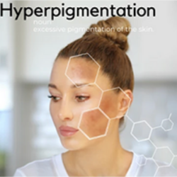 Hyperpigmentation - What is it? & How to Treat it