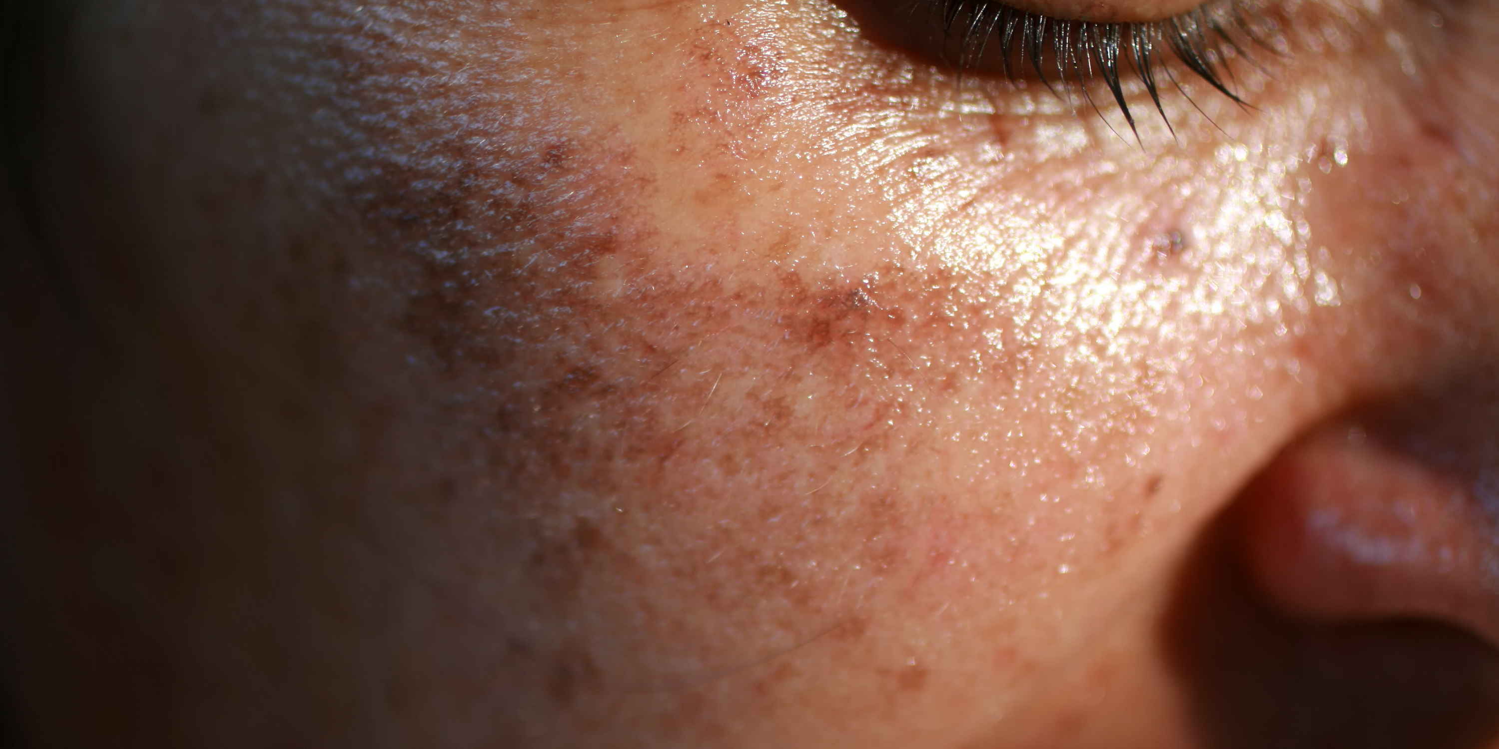 Are Age Spots Inevitable?