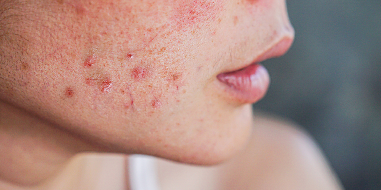 Should You Wear Makeup with Acne?