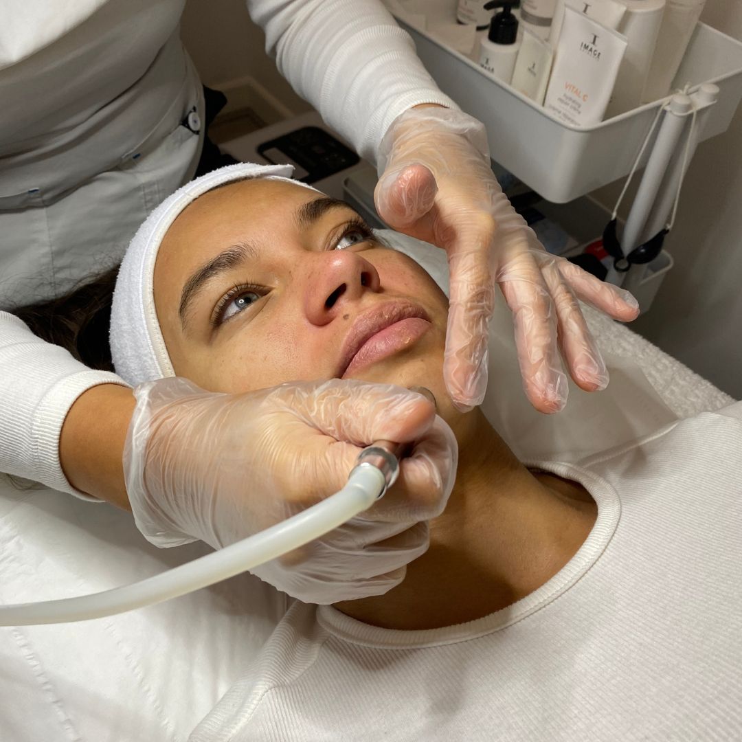 The benefits of microdermabrasion