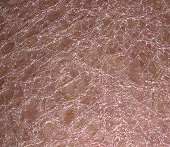 DRY SKIN