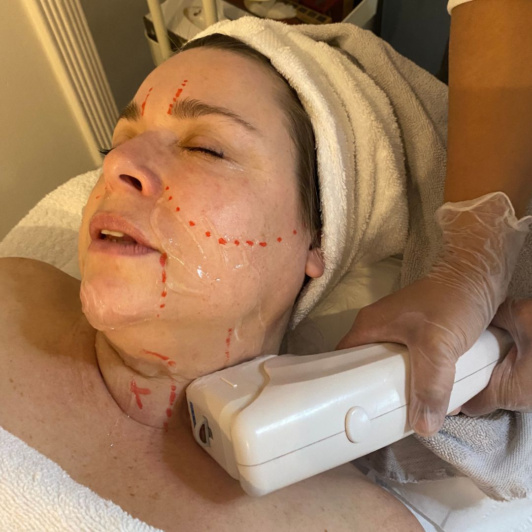 HIFU Full Face &amp; Neck