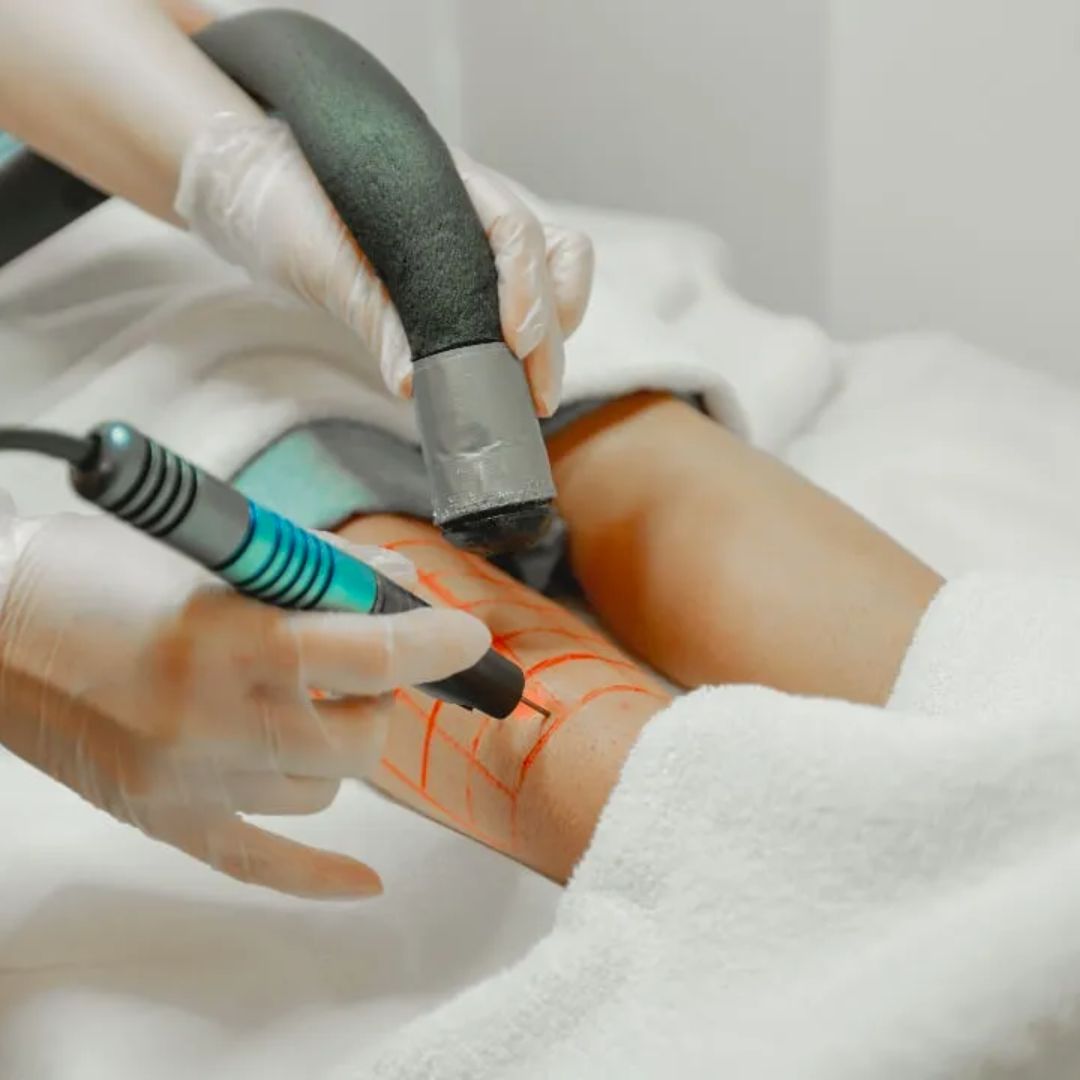 Laser Hair Removal 50 mins x6