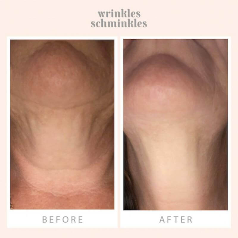 Wrinkles Schminkles WRINKLES SCHMINKLES Neck Smoothing Kit | Beautology.